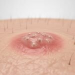 Hemorrhoids or Herpes