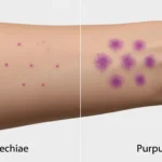 petechiae or purpura